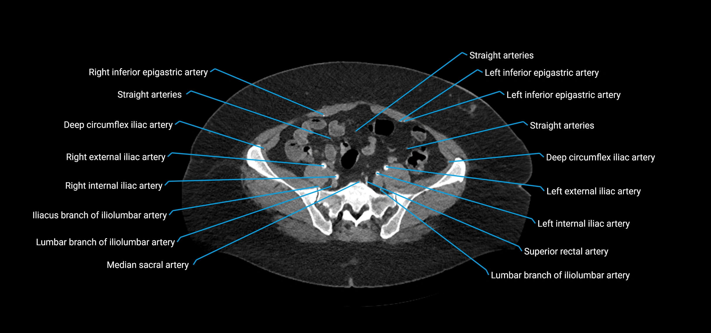 CTA abdomen axial cross sectional anatomy labelled image_186 (2).webp